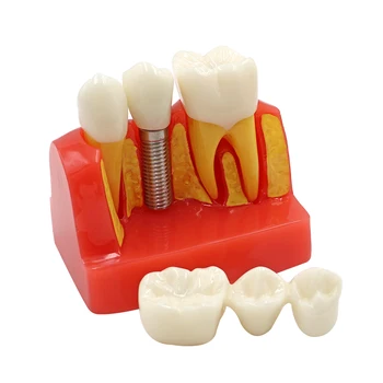 Зъбни импланти Модел на Зъбите на 4/Четири Пъти Феята на Смола Кварцевая Гума Модел на Зъбите Зъболекар Образователна Технология Патологична Модел